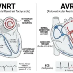 avnrt vs avrt
